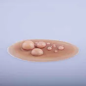 Abscess Wound