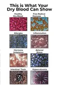 Dry Blood Analysis