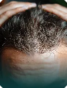 SMP Hairline Density