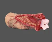 COMPLETE ARM AMPUTATION – RESCUE RANDY