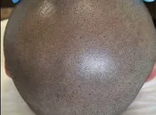 SMP (Medical Scalp Micro-Pigmentation)
