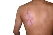 2nd Degree Burn Trauma Tattoo – Small
