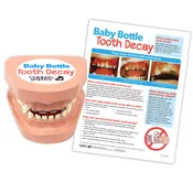 Baby Bottle Tooth Decay Model Set