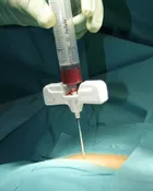 Bone Marrow Biopsy / Aspiration Needles